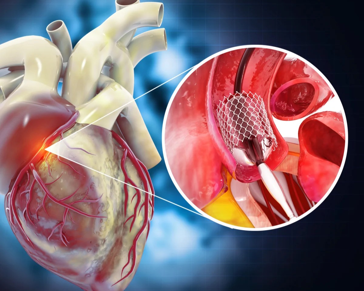Interventional Cardiology