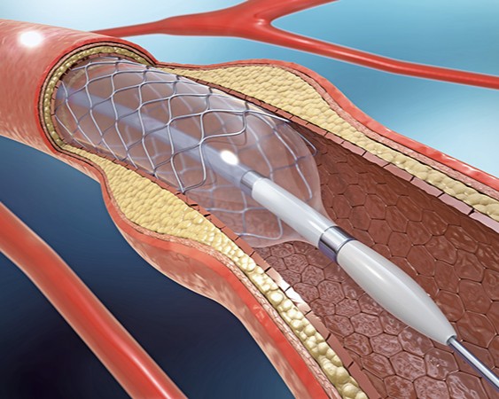 Coronary Angioplasty / PCI