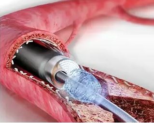 Laser Angioplasty