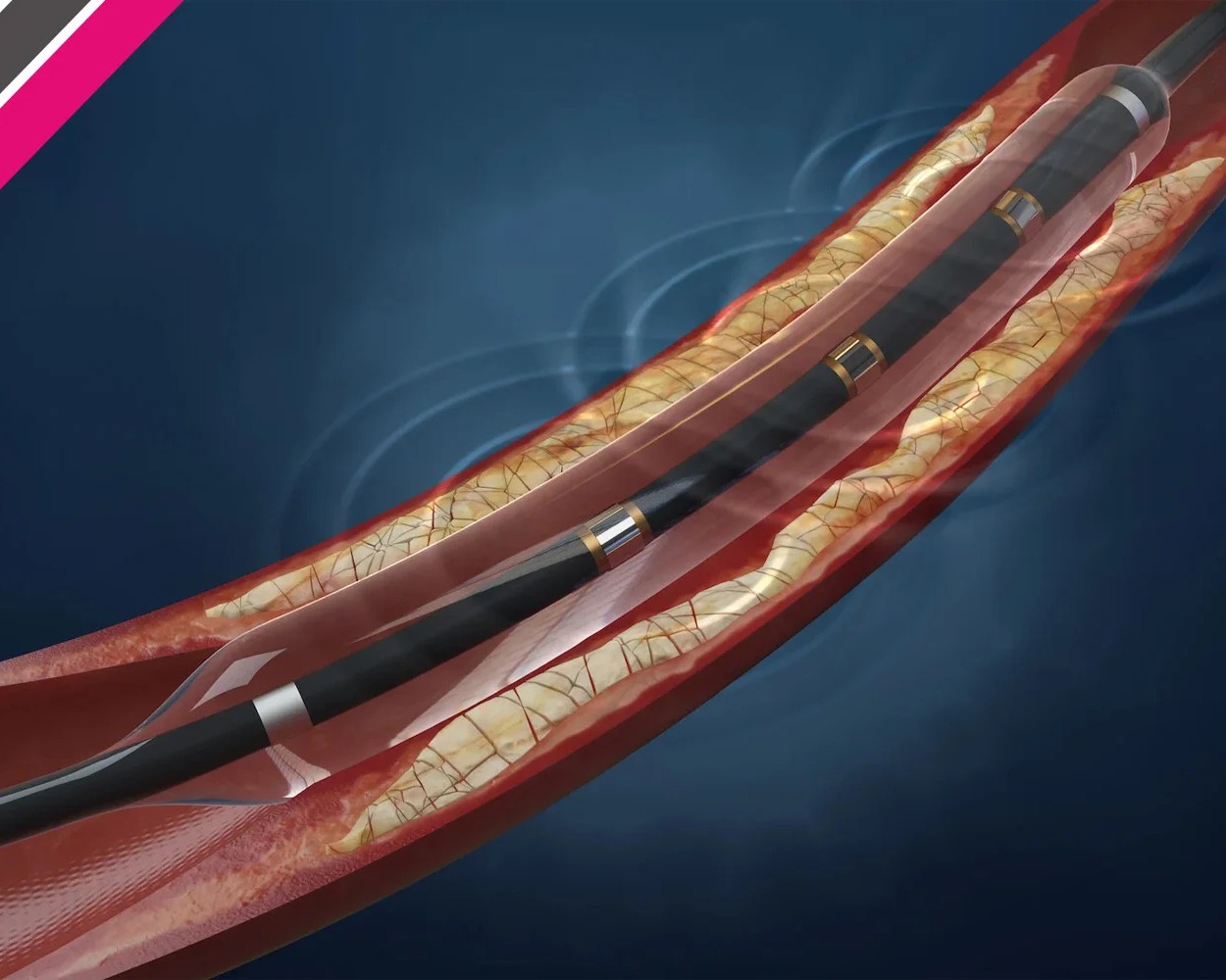 Intravascular Lithotripsy